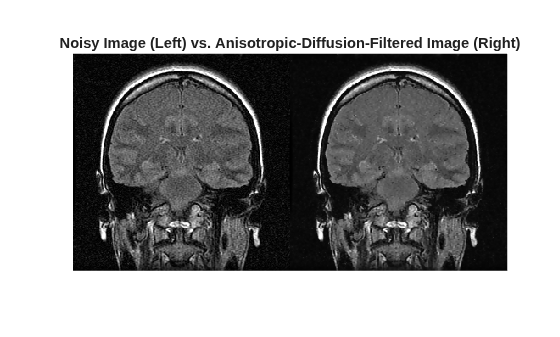 Figure contains an axes object. The hidden axes object with title Noisy Image (Left) vs. Anisotropic-Diffusion-Filtered Image (Right) contains an object of type image.