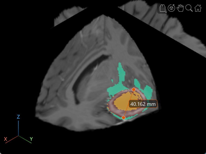Zoomed in display showing the tumor region with a line annotation across the tumor. The line label indicated the size of the tumor is 40.162 mm.