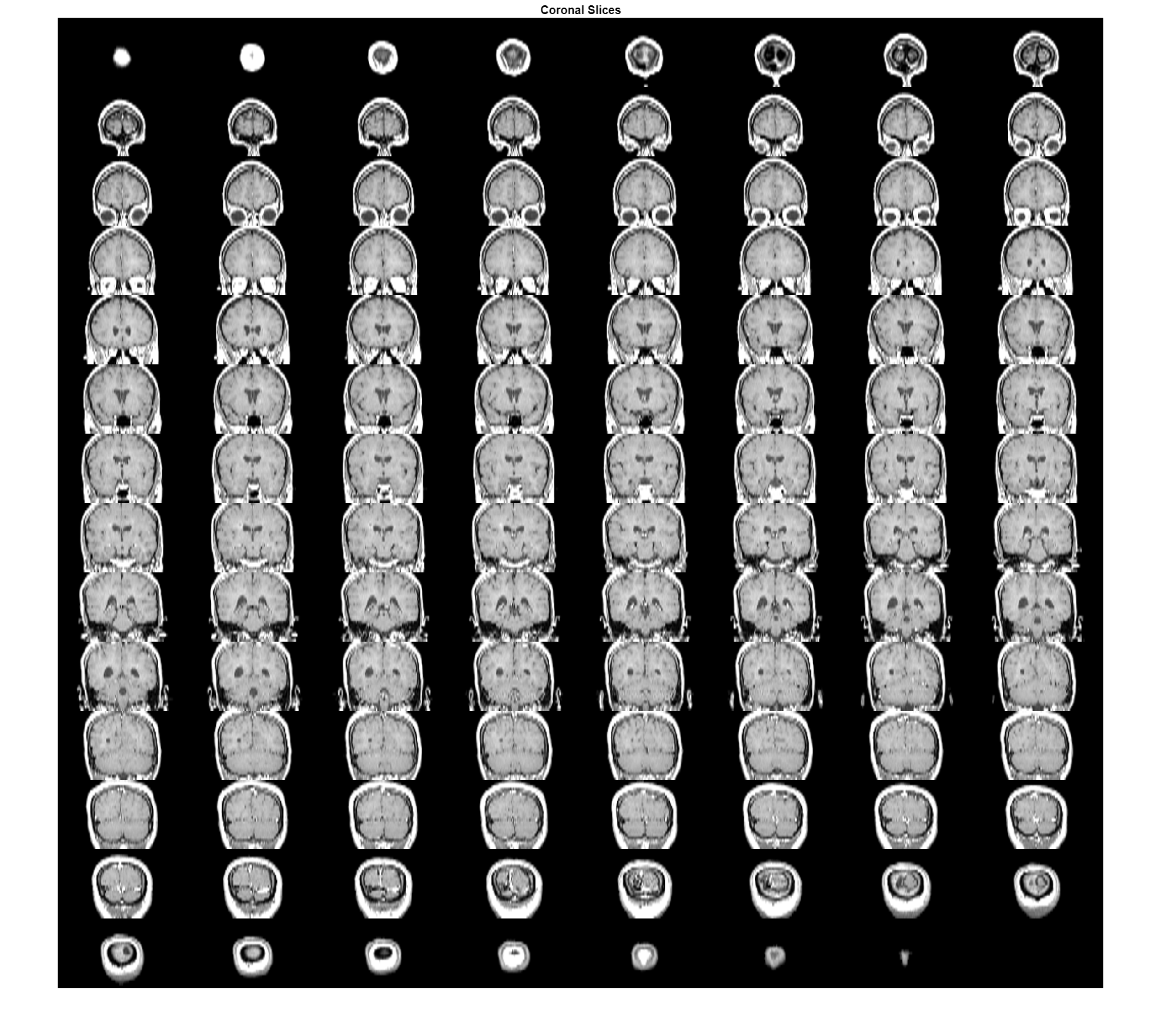 Figure contains an axes object. The hidden axes object with title Coronal Slices contains an object of type image.