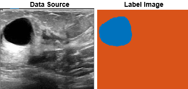 Breast ultrasound image frame is on the left, and the corresponding tumor label image is on the right
