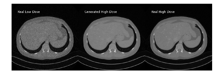 Unsupervised Medical Image Denoising Using CycleGAN