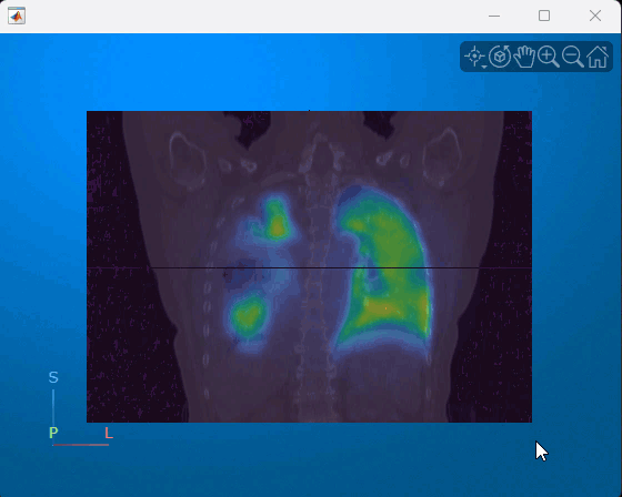 Animation of viewer window showing how to scroll through coronal slices of the multimodal CT and PET display.