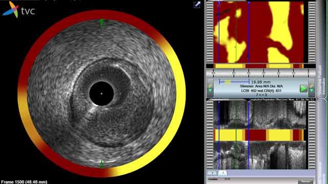 Infraredx Accelerates FPGA Development on First-of-Its-Kind Intravascular Imaging System